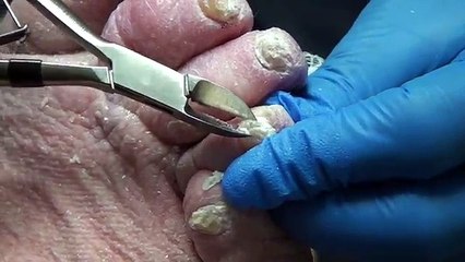 Thick Fungal Nails and Wound on Diabetic Patient with Lymphedema