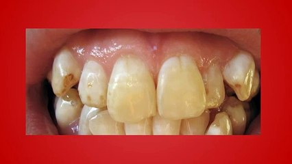 Professional Teeth Whitening- Facts You Should Know...