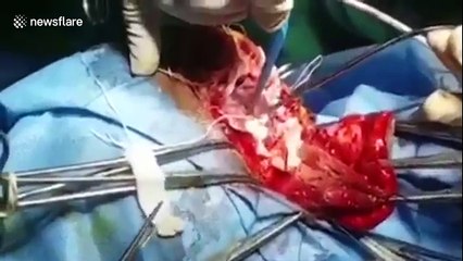 Patient watches movie, hums along during brain surgery