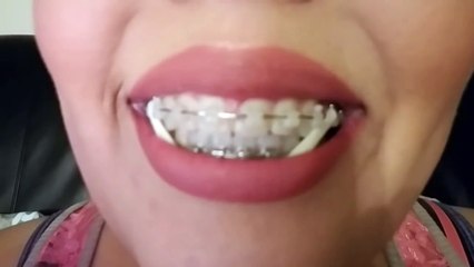 Braces Vlog #6 (Update & Close Up Month 6)