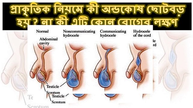 প্রাকৃতিক নিয়মে কী অন্ডকোষ ছোট বড় হয় না কী এটি কোন রোগের লক্ষণ দেখুন ভিডিও