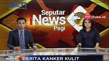 Digerogoti Kanker Kulit, Jemadi Butuh Bantuan untuk Berobat