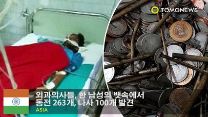 외과의사들, 한 남성의 뱃속에서 동전 263개, 나사 100개 발견