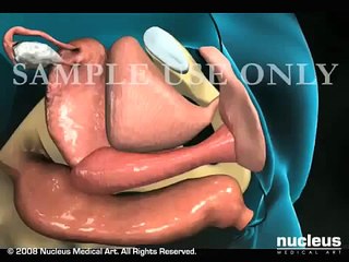 Cách khám phụ khoa bằng phễu mỏ vịt