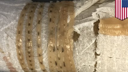 Tapeworms: Sushi-lover finds 5-ft-long tapeworm chillin inside - TomoNews