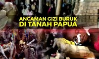 Soal Campak dan Gizi Buruk di Asmat Papua