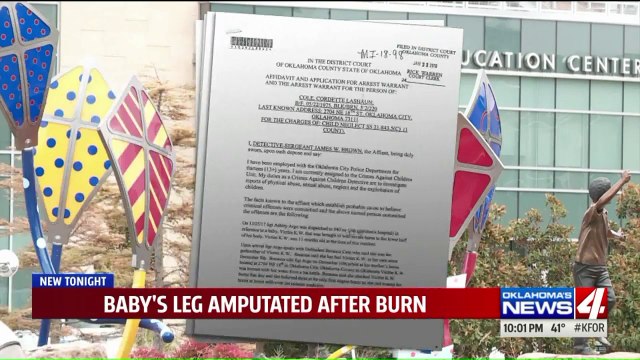 Baby's Leg Amputated Due to Severe Burns, 2 Women Arrested