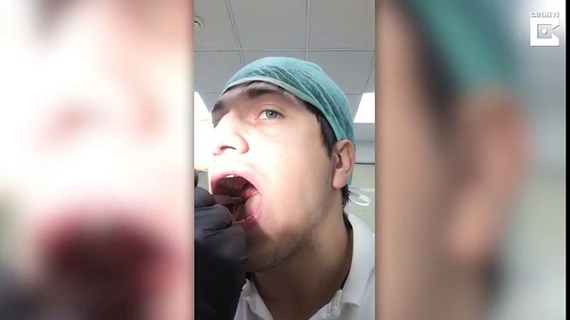 Russian dentist pulls out his own wisdom tooth
