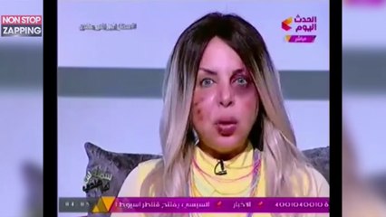 Battue par son mari, une présentatrice égyptienne anime son émission le visage "tuméfié" (Vidéo)