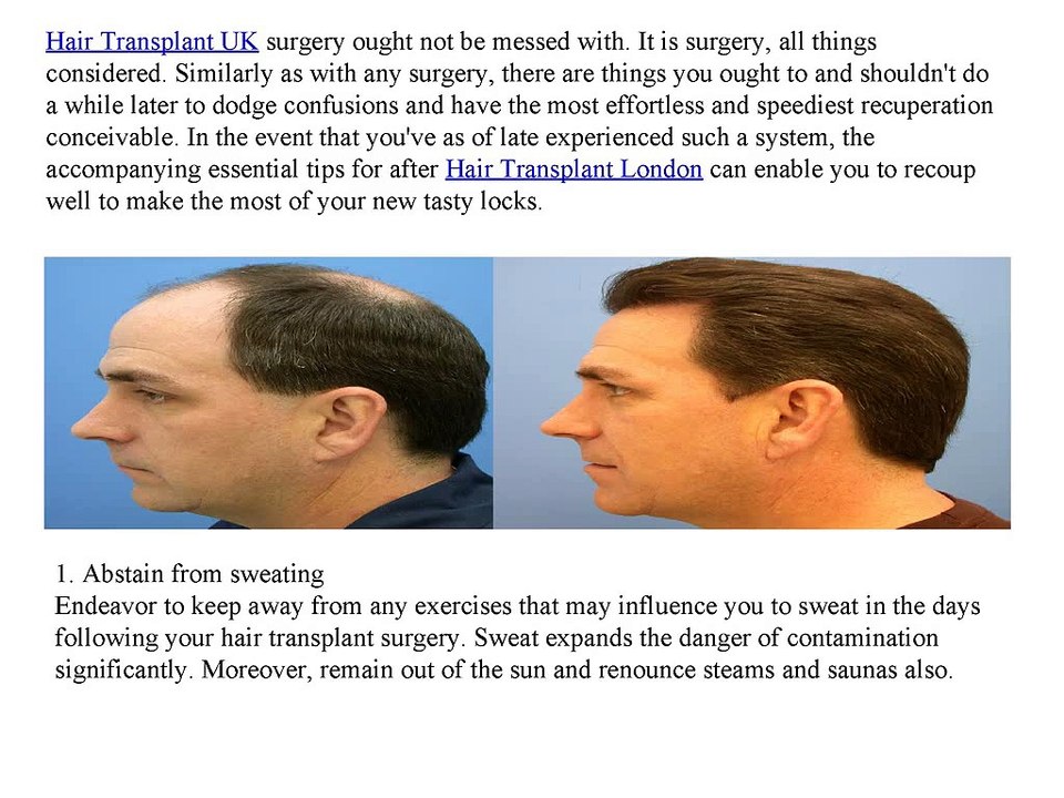 5_Most_Important_Post_Hair_Transplant_Tips