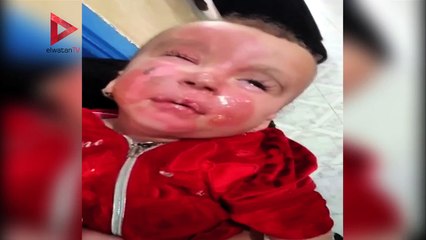 "إهمال ممرضة".. طفلة دخلت مستشفى الحامول لجلسة بخار خرجت مشوهة