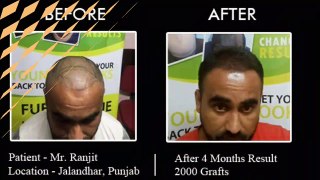 Patient Review - FUE 2000 grafts - Hair Transplant in Jalandhar