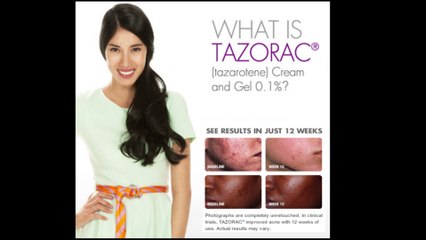 Tazret Tazarotene Tazorac Cream (Rosacea, Acne, Scars) by OKDERMO.com