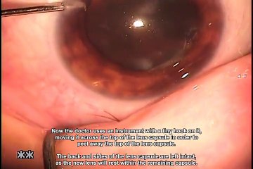 Opération de la cataracte filmée comme si vous y étiez !! BEURK