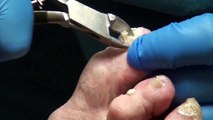 Trimming Really Thick Nails in Podiatry office