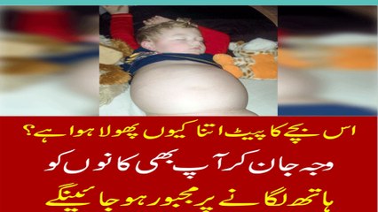 Doncaster Boy Has A Condition That Makes Him Look Pregnant