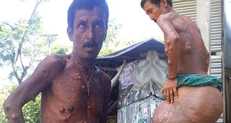 Kalçasında 40 Yıldır Büyüyen Tümör, Bangladeşli Köylünün Hayatını Zehir Ediyor