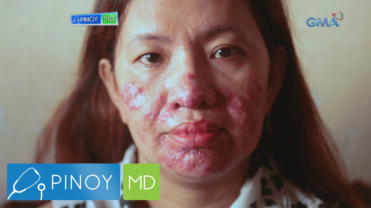 Pinoy MD: Sanhi ng adult acne sa mga kababaihan...