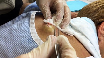 Infected Cyst on Mid-back