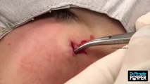 The Cyst that GOT Dr Pimple Popper!