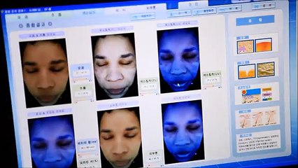 Tanya's Thread Lifting for Saggy Skin in Seoul, Korea