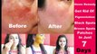 Remove Pigmentation Easily : How to Remove Black Spots and Dark Spots on Face