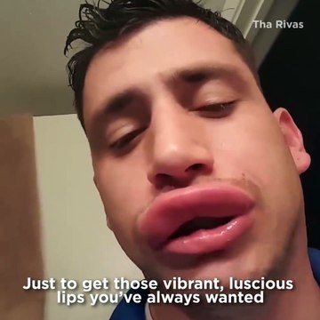 Pas besoin de botox quand tu t'es fait piquer par une abeille sur les lèvres!