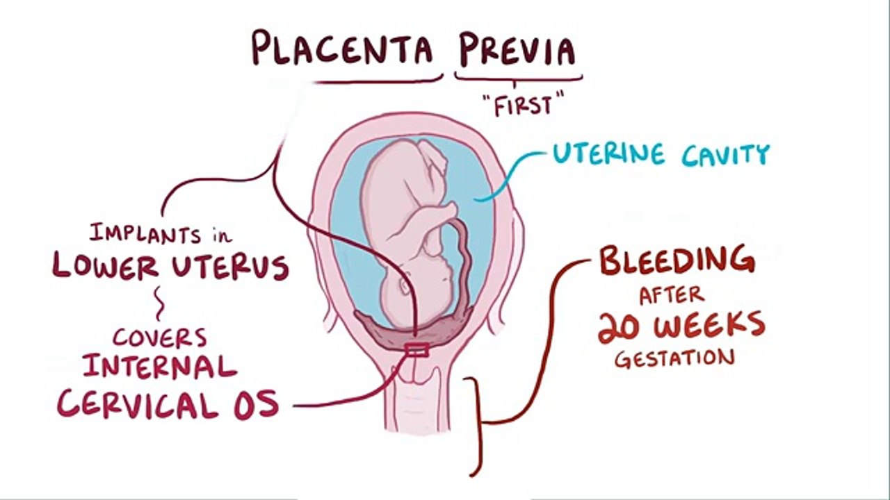 Placenta previa - causes, symptoms, diagnosis, treatment, pathology