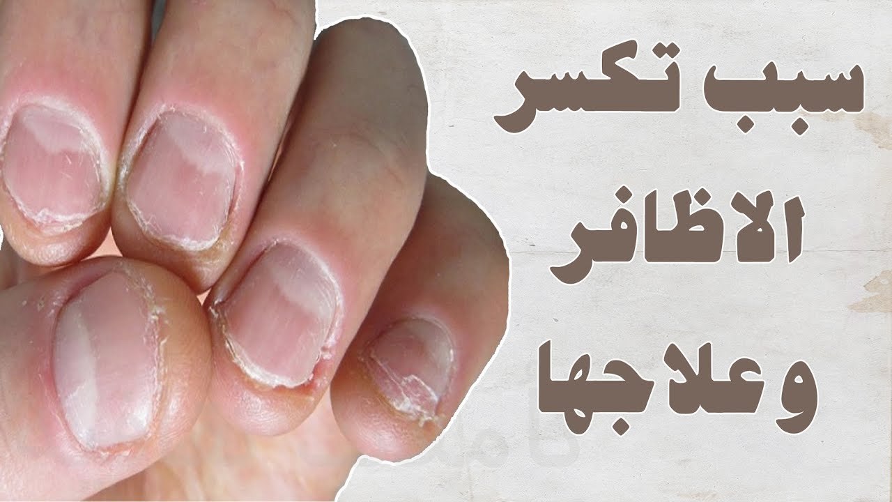 سبب تكسير الأظافر ( علامات تشخص الأمراض ) ... #حكاية_ كل_ بيت