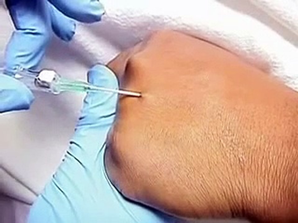 IV Cannulation Technique