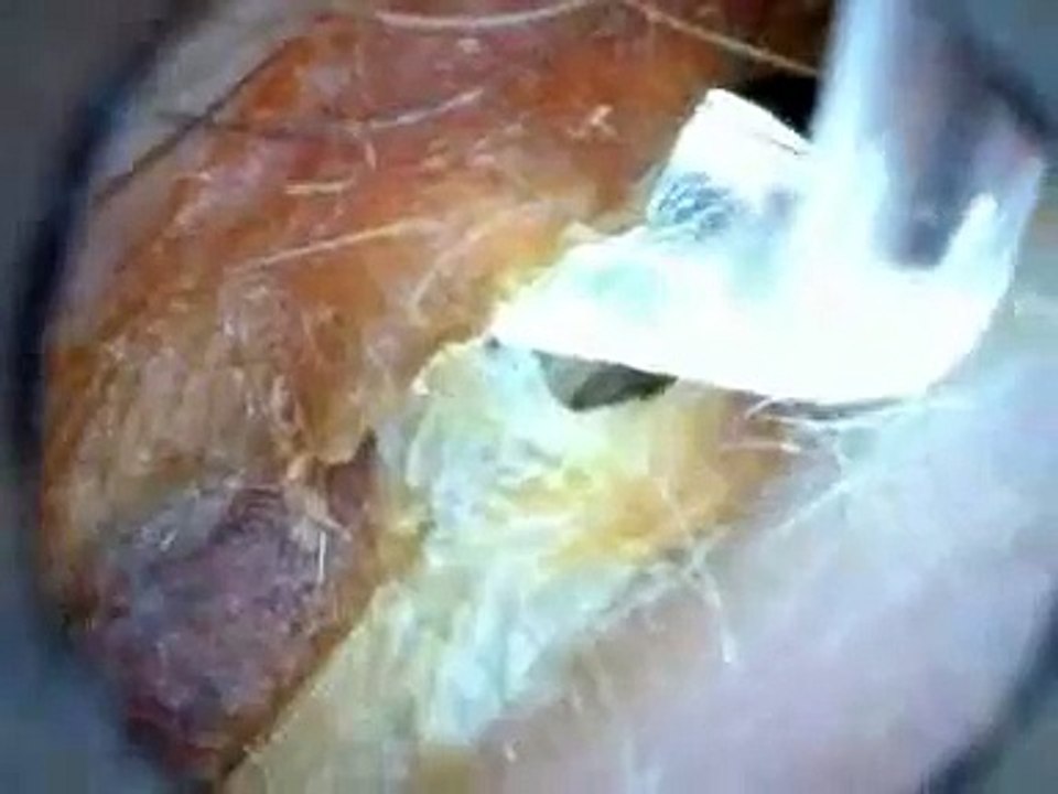 Ear Wax Removal Blocked ear Illuminated Jobson Horn