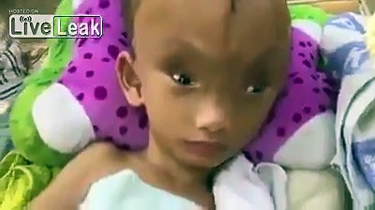 Six-year-old boy with giant crack in his skull
