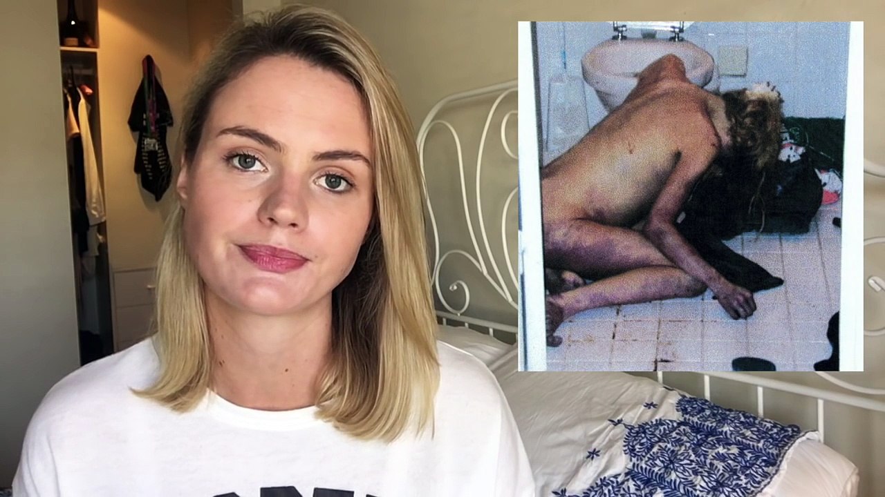 The Photo Everyone with an Eating Disorder Should See (WARNING: GRAPHIC IMAGE)