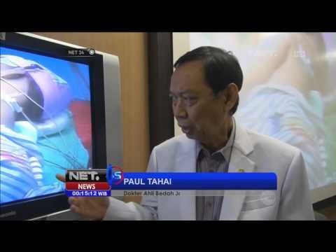 Bayi kembar siam asal Banyuwangi Nurul dan Rahma akhirnya berhasil dipisahkan - NET24