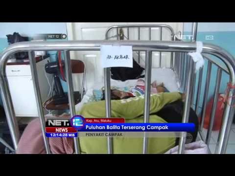 Puluhan Balita di Kepulauan Aru Terserang Campak -NET12