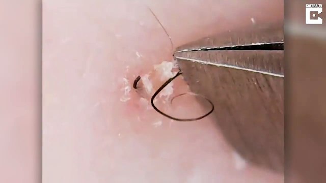 Woman Who Post Grizzly Videos Plucking Her Ingrown Hairs Out Unlikely Social Media Star With More than 12,000 Instagram Followers