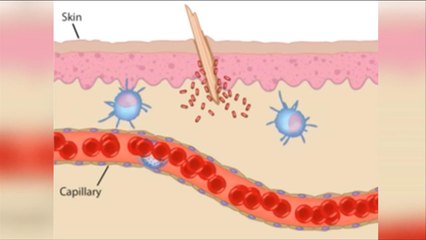 هذا الصباح- تقنيات جديدة تساعد في التئام الجروح