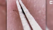 Woman Who Post Grizzly Videos Plucking Her Ingrown Hairs Out Unlikely Social Media Star With More than 12,000 Instagram Followers