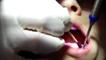 Dental Cleaning Teeth Polish