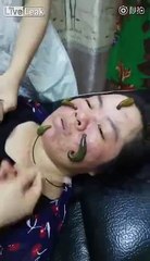 Çinli kadınlar sülük tedavisi - acemikamera