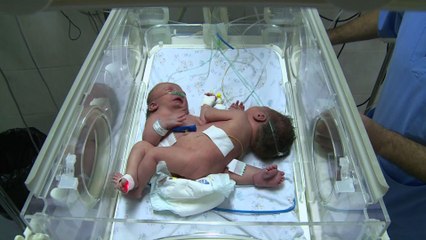 Appel pour une opération à l'étranger de siamoises nées à Gaza