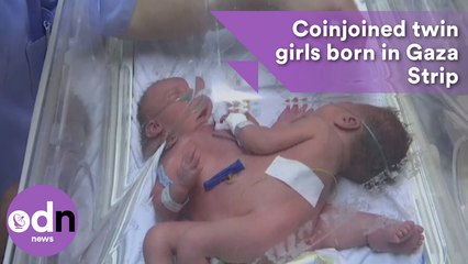 Conjoined twin girls born in Gaza Strip