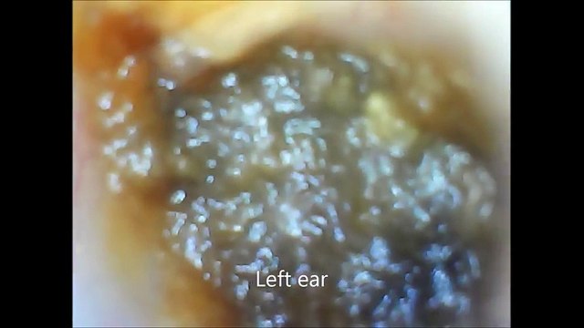 Inside SUPER CLOGGED EARS with digital otoscope