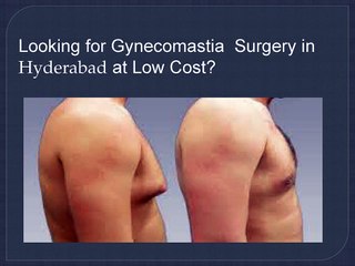 Gynecomastia Cost in Hyderabad | Gynecomastia Hyderabad