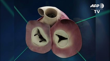 Anuncian primer implante de corazón artificial en Kazajistán