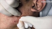 Blackheads s Forest - I BET YOU NEVER SEEN BEFORE