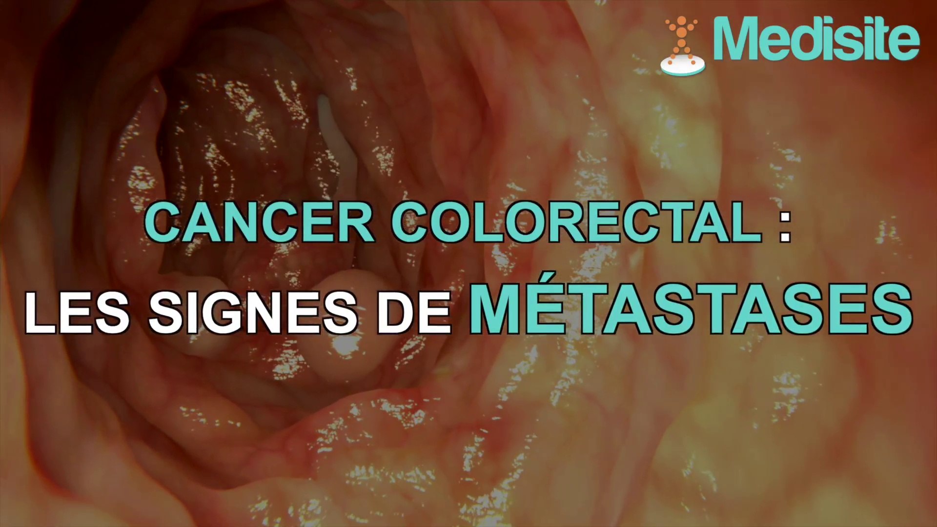 Cancer colorectal : les signes de métastases