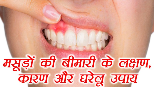 Gums Disease Symptoms & Treatment | मसूड़ों की बीमारी के लक्षण, कारण और घरेलू उपाय | Boldsky