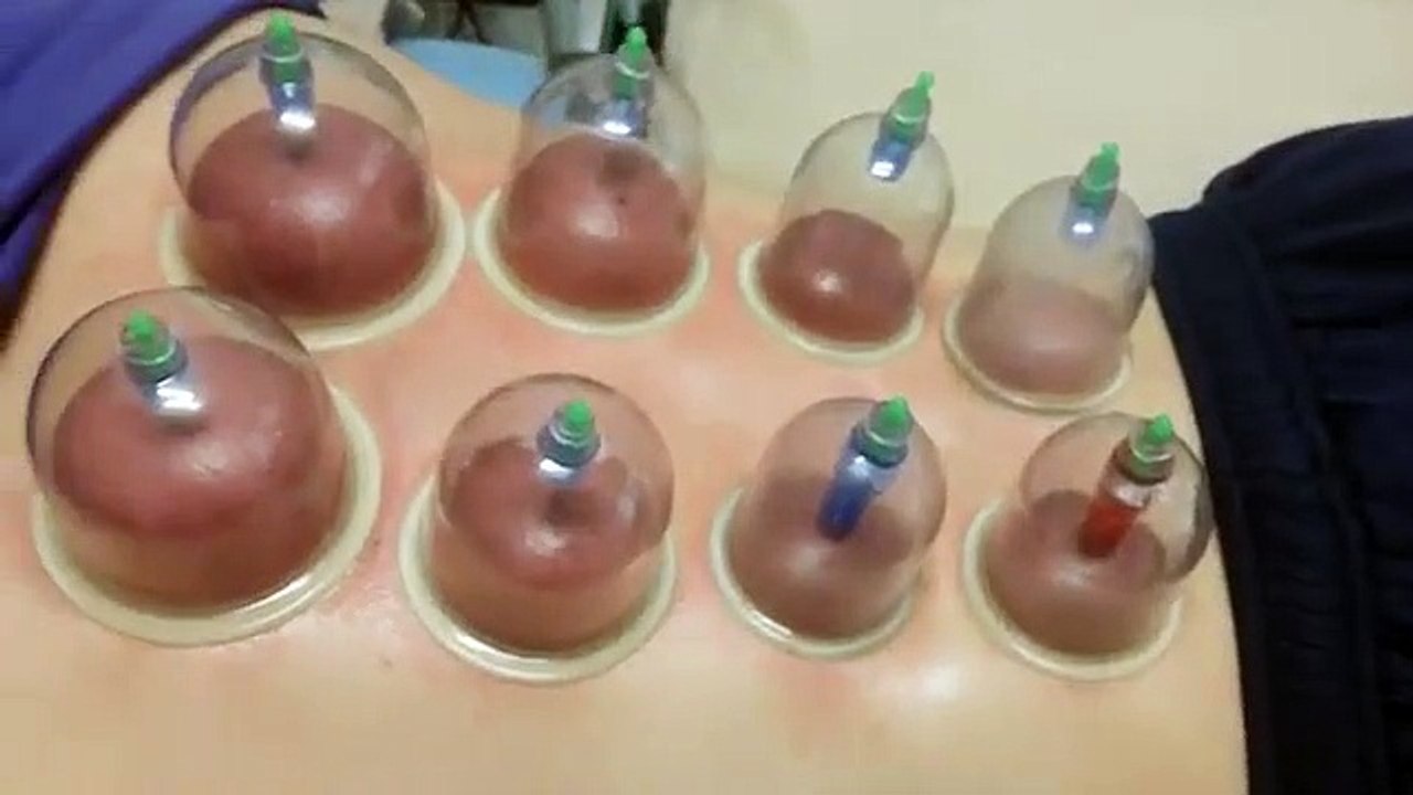Cupping paraspinals