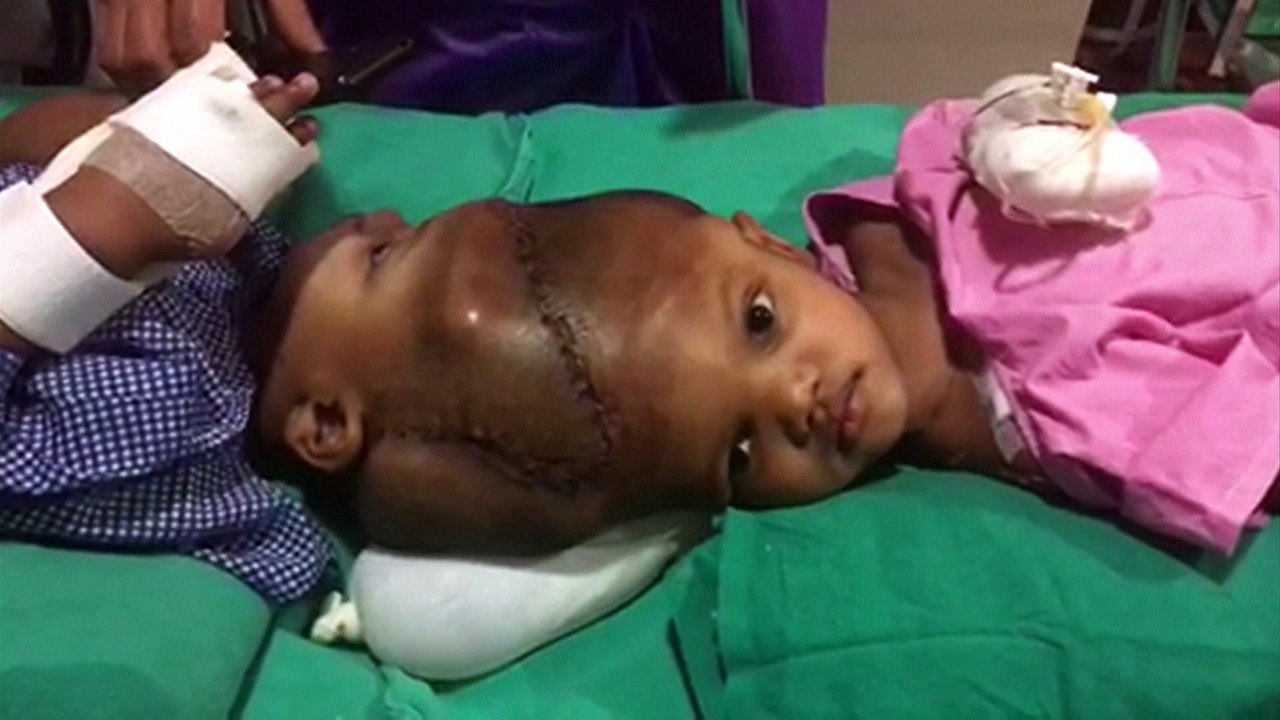 Des docteurs indiens séparent des bébés siamois